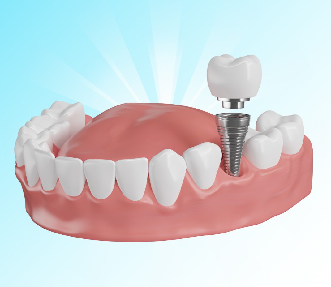 Dental implant illustration