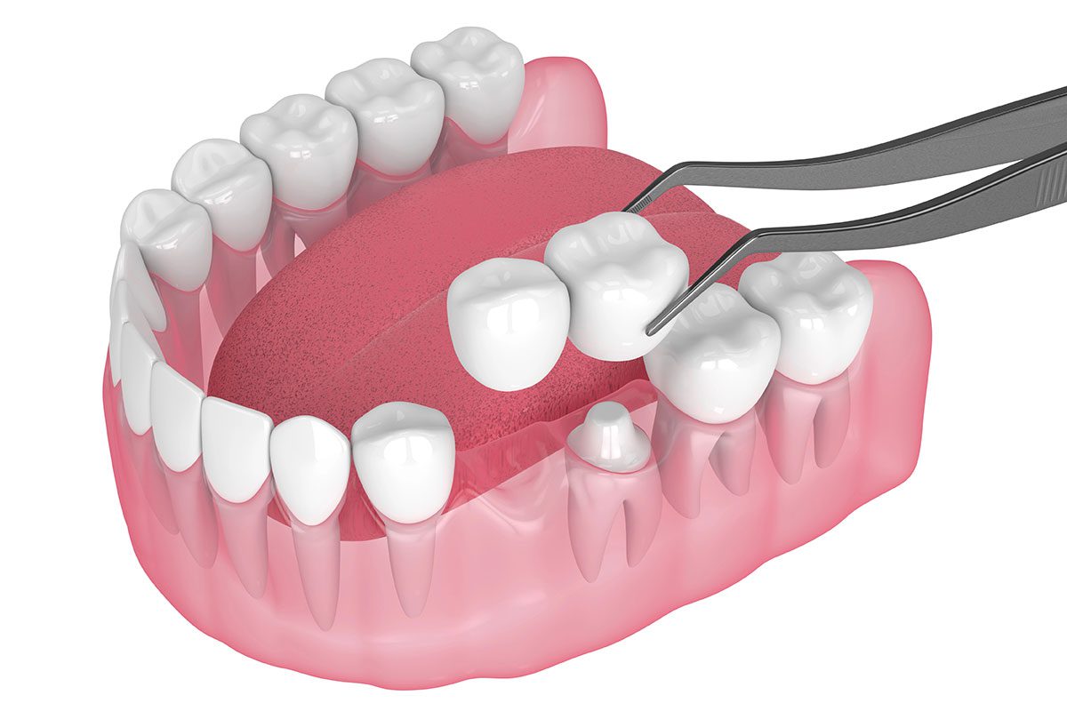 Ceramic crown and bridge placement