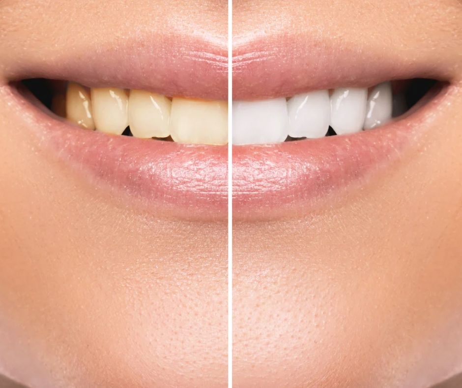 Before and after teeth whitening